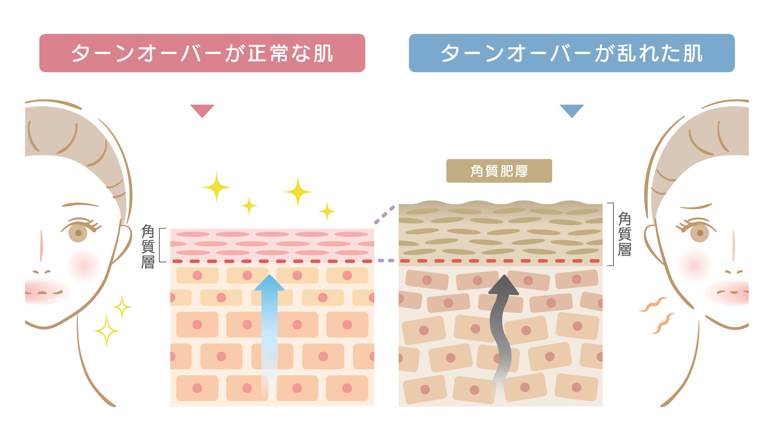 ターンオーバーの乱れ